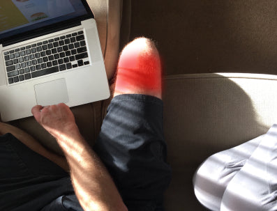 Toasted Skin Syndrome: Are Your Thighs Getting Burned by Your Laptop?