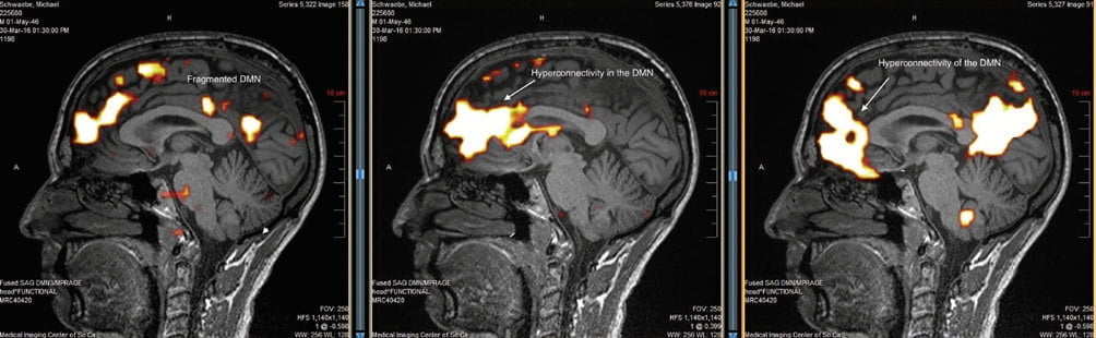 Brain MRI in of Electrosensitivity Sufferers